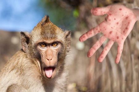 توصیه‌های بهداشتی برای بیماری آبله میمون