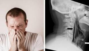 سوراخ شدن گلو بر اثر نگه‌ داشتن عطسه