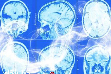 سیگار کشیدن می تواند مغز را کوچک کند