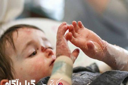 تولید پانسمان بیماران پروانه‌ای برای اولین بار در کشور