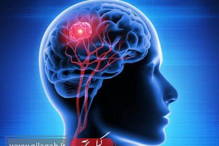 رازهای پیشگیری از سکته از زبان متخصصان مغز و اعصاب